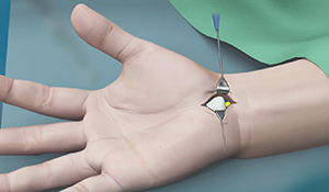 Fractures of the Hand and Fingers