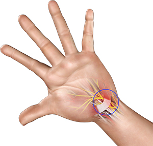 Fractures of the Hand and Fingers