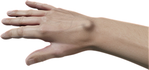 Ganglion Cyst