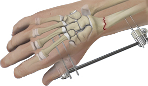 Hand Fracture