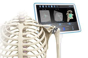 Computer Navigation for Shoulder Replacement