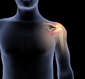 Rotator Cuff Repair