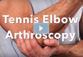 Patient Testimonial of Tennis Elbow Arthroscopy