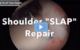 Patient Testimonial of Shoulder SLAP Tear Repair